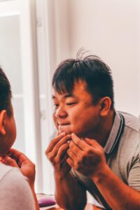 ニキビ跡のクレーターを自宅で効果的にケアする方法は？